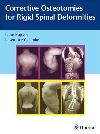 Corrective Osteotomies for Rigid Spinal Deformities (PDF Publisher)