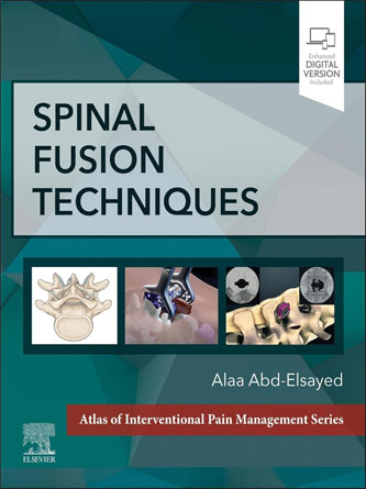 Spinal Fusion Techniques (PDF Publisher)