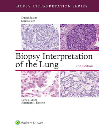 Biopsy Interpretation of the Lung (Biopsy Interpretation Series), 2nd Edition - EPUB + Converted PDF