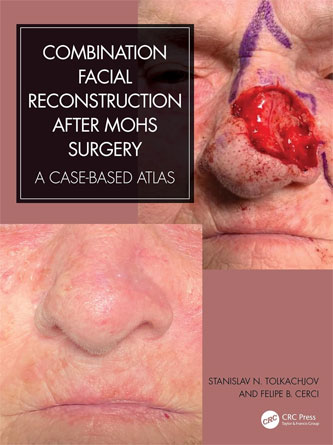 Combination Facial Reconstruction after Mohs Surgery: A Case Based Atlas (Original PDF)