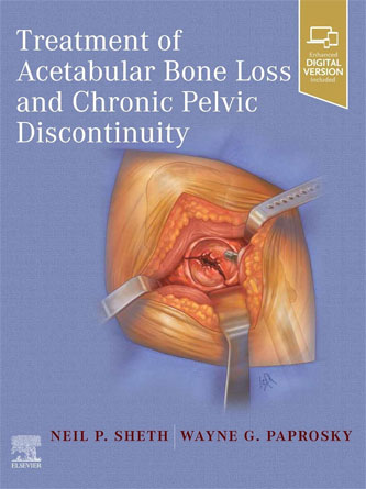 Treatment of Acetabular Bone Loss and Chronic Pelvic Discontinuity (Original PDF + Video)