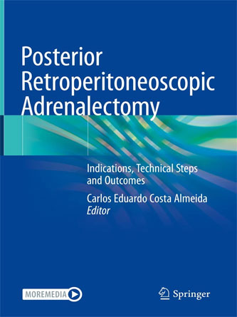 Posterior Retroperitoneoscopic Adrenalectomy: Indications, Technical Steps and Outcomes (PDF)