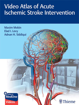 Video Atlas of Acute Ischemic Stroke Intervention (PDF + Video Download)