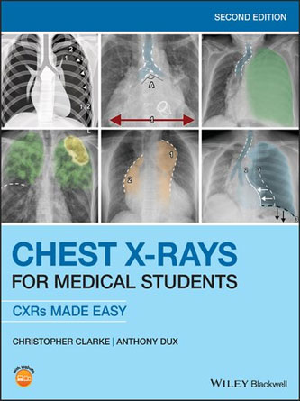 Chest X-Rays for Medical Students: CXRs Made Easy 2st Edition (PDF Publisher)